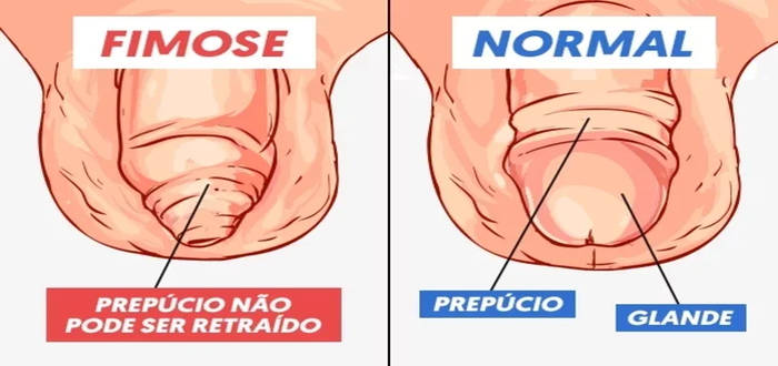 o que é fimose